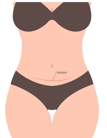 Tummy Tuck Image